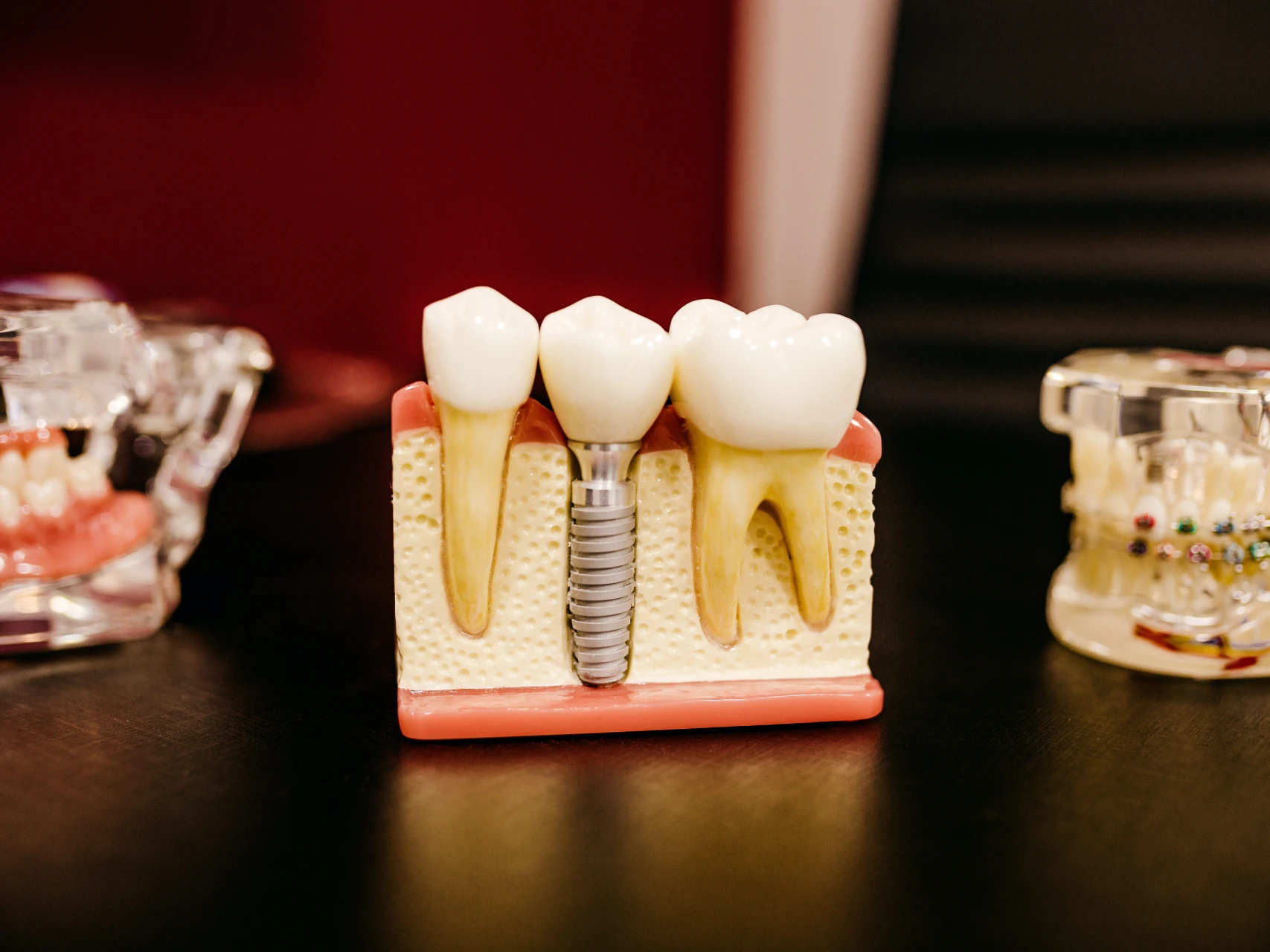 model of a single tooth dental implant | cost of dental implants in Milwaukee, WI