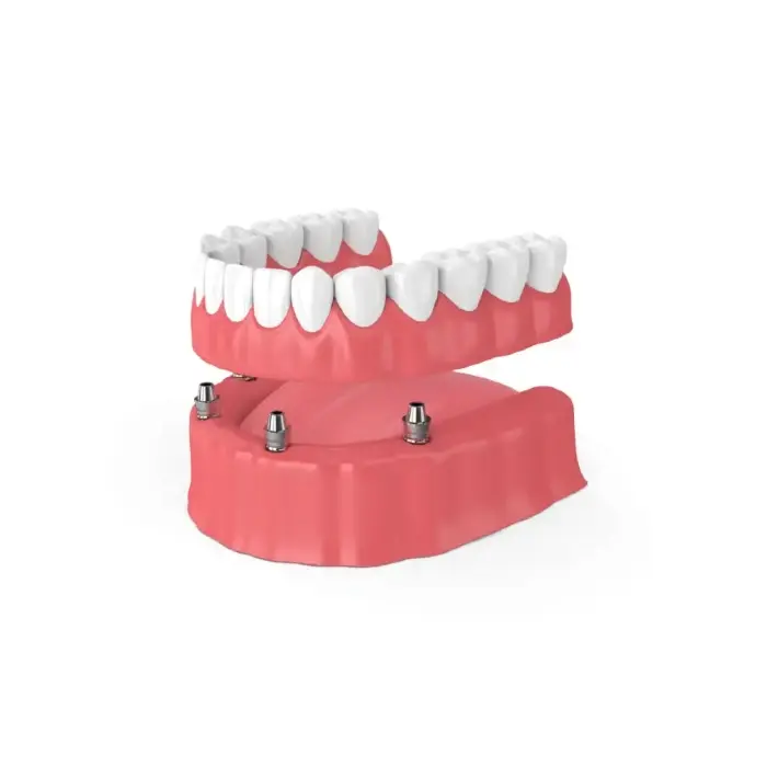 snap-in implant dentures Milwaukee, WI