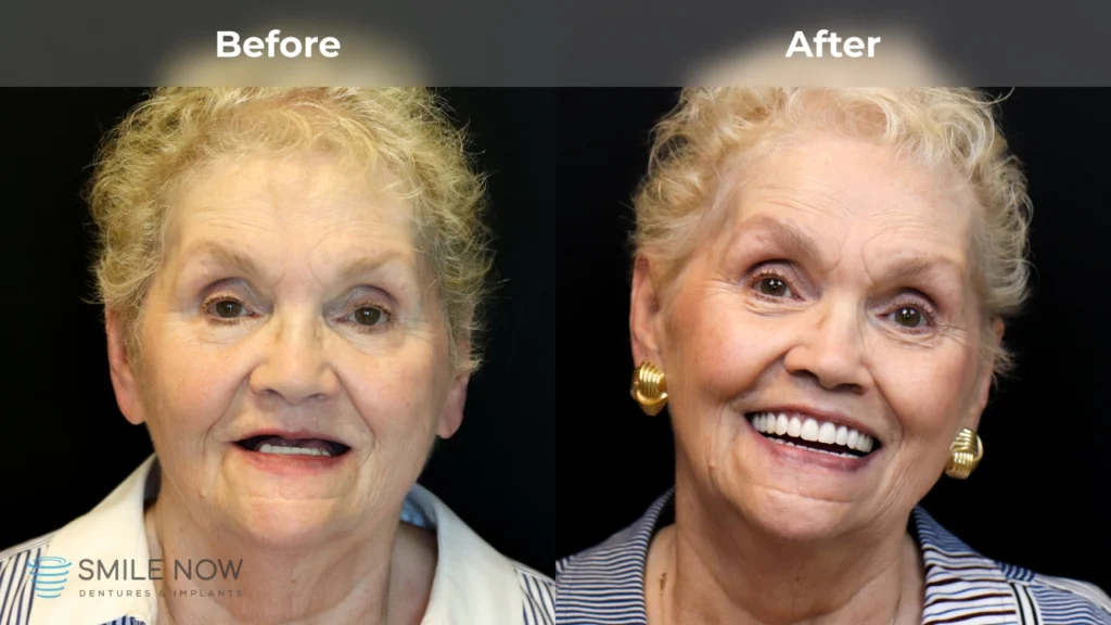 Before and after dental implants in Milwaukee, WI at Smile Now Milwaukee Dentures and Implants