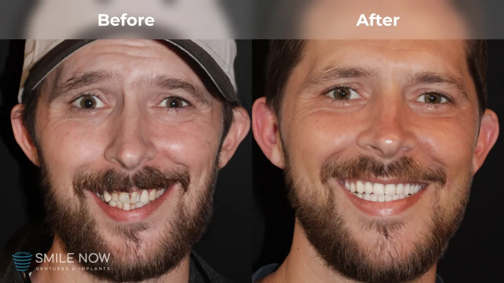 Before and after dental implants in Milwaukee, WI at Smile Now Milwaukee Dentures and Implants