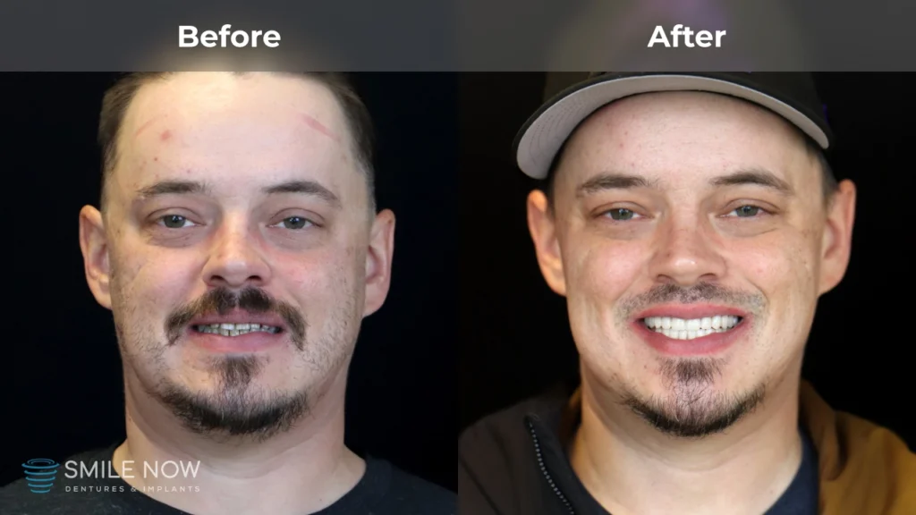 Before and after dental implants in Milwaukee, WI at Smile Now Milwaukee Dentures and Implants