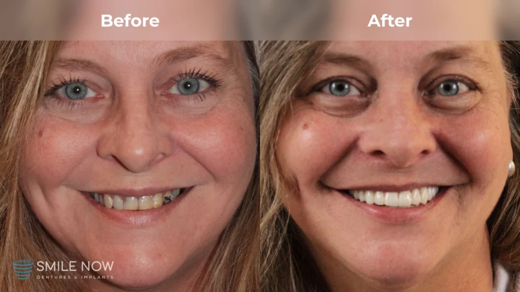 Before and after dental implants in Milwaukee, WI at Smile Now Milwaukee Dentures and Implants