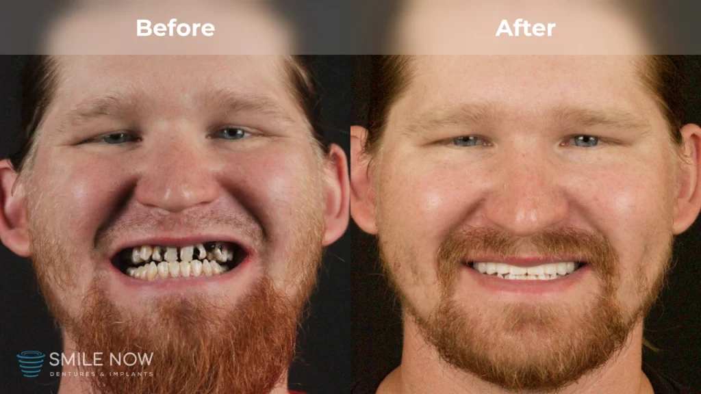 Before and after dental implants in Milwaukee, WI at Smile Now Milwaukee Dentures and Implants