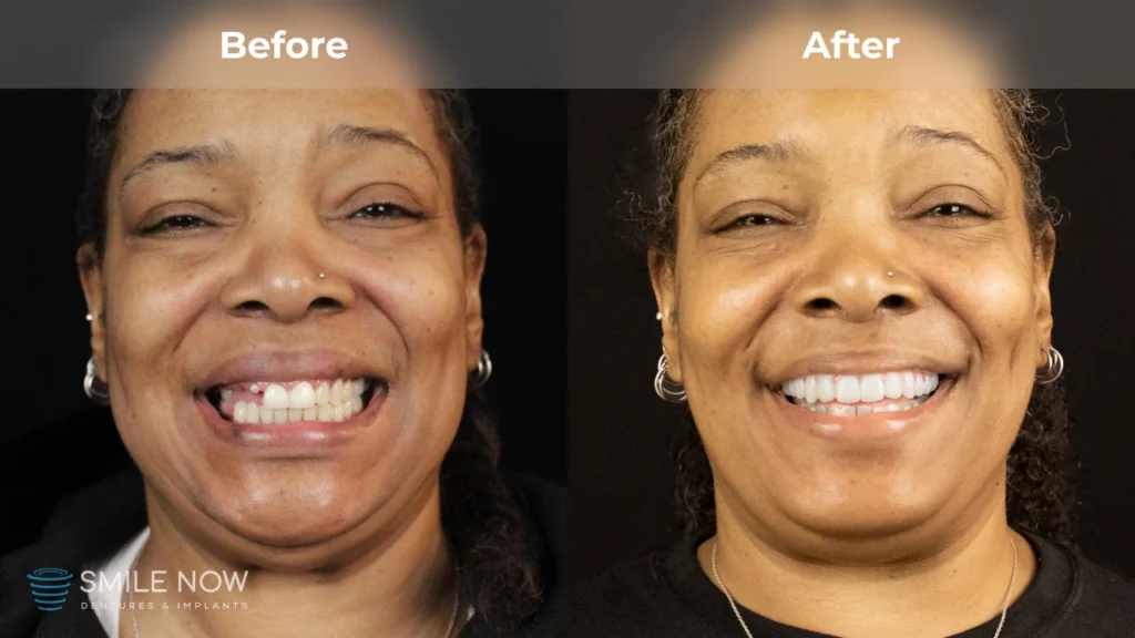 Before and after dental implants in Milwaukee, WI at Smile Now Milwaukee Dentures and Implants