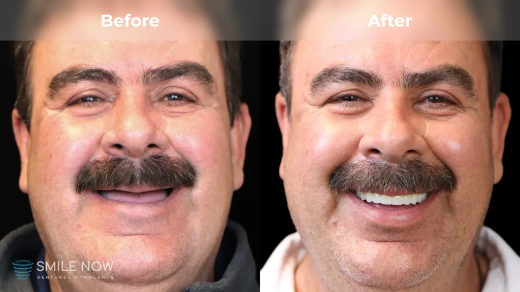 Before and after dental implants in Milwaukee, WI at Smile Now Milwaukee Dentures and Implants