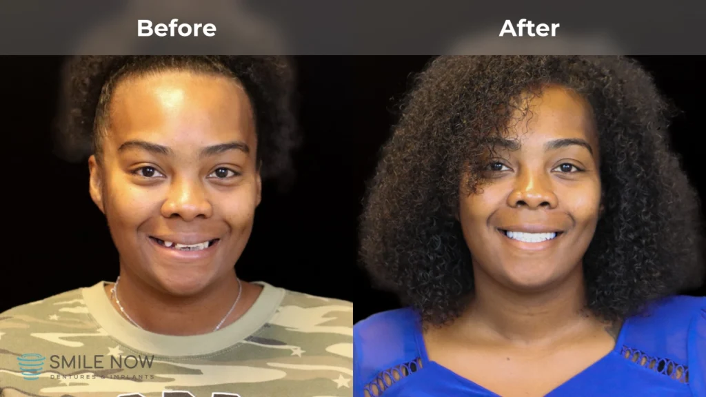 Before and after dental implants in Milwaukee, WI at Smile Now Milwaukee Dentures and Implants