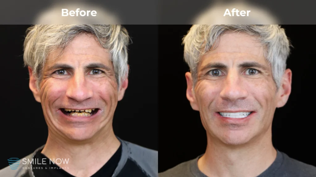 Before and after dental implants in Milwaukee, WI at Smile Now Milwaukee Dentures and Implants