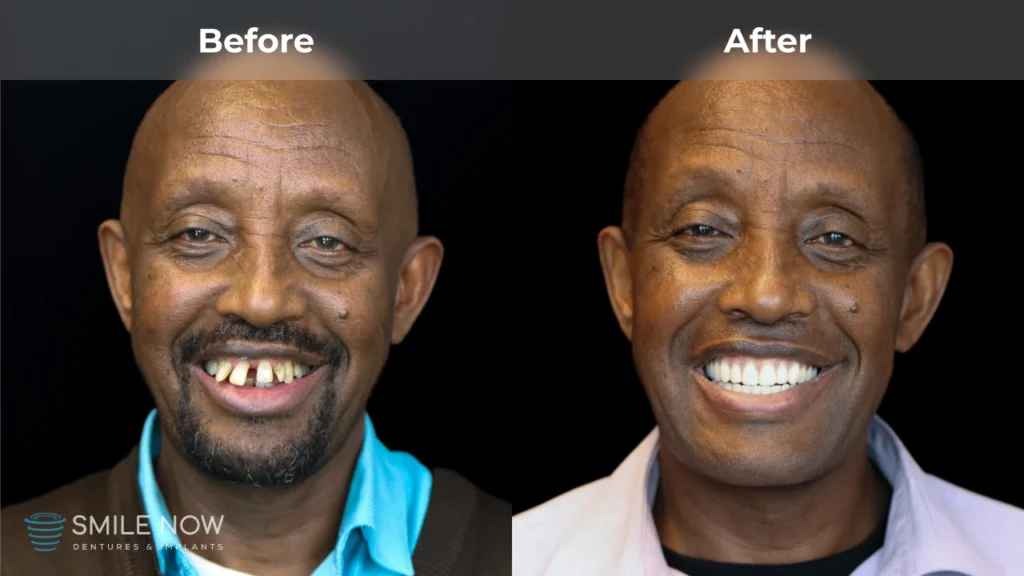 Before and after dental implants in Milwaukee, WI at Smile Now Milwaukee Dentures and Implants