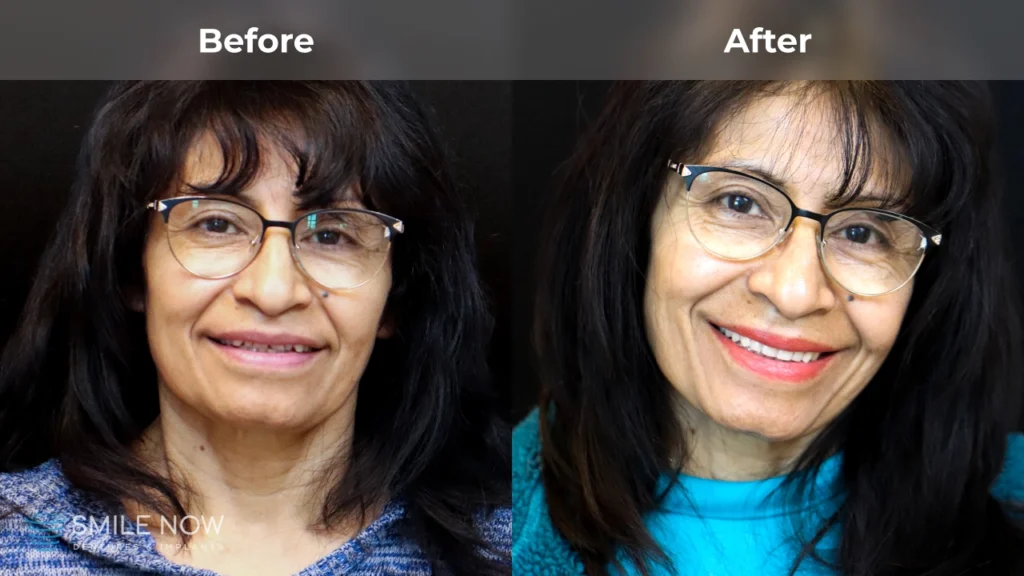 Before and after dental implants in Milwaukee, WI at Smile Now Milwaukee Dentures and Implants