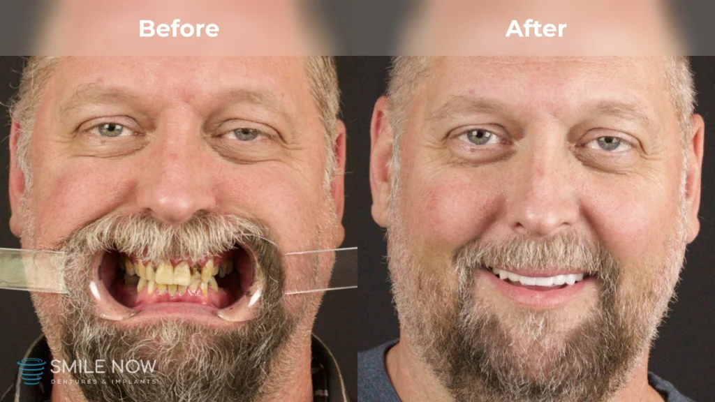 Before and after dental implants in Milwaukee, WI at Smile Now Milwaukee Dentures and Implants