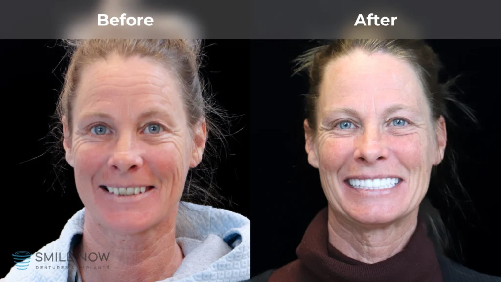 Before and after dental implants in Milwaukee, WI at Smile Now Milwaukee Dentures and Implants