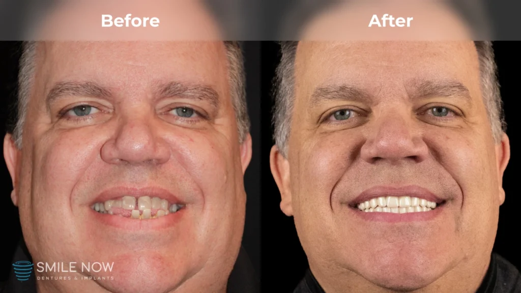 Before and after dental implants in Milwaukee, WI at Smile Now Milwaukee Dentures and Implants