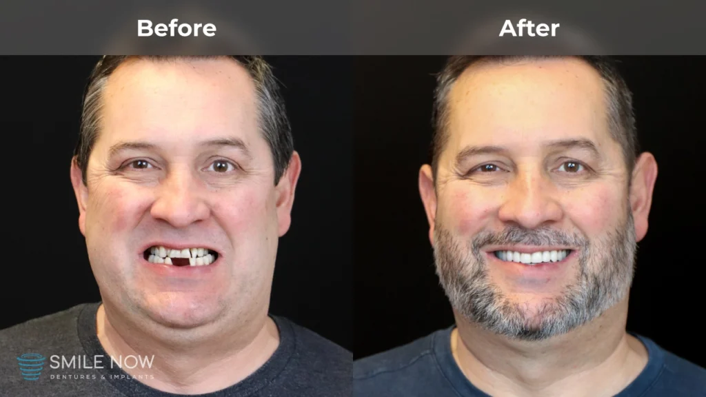 Before and after dental implants in Milwaukee, WI at Smile Now Milwaukee Dentures and Implants