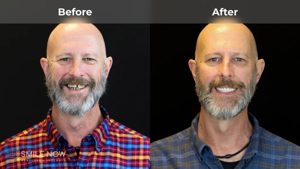 Before and after dental implants in Milwaukee, WI at Smile Now Milwaukee Dentures and Implants