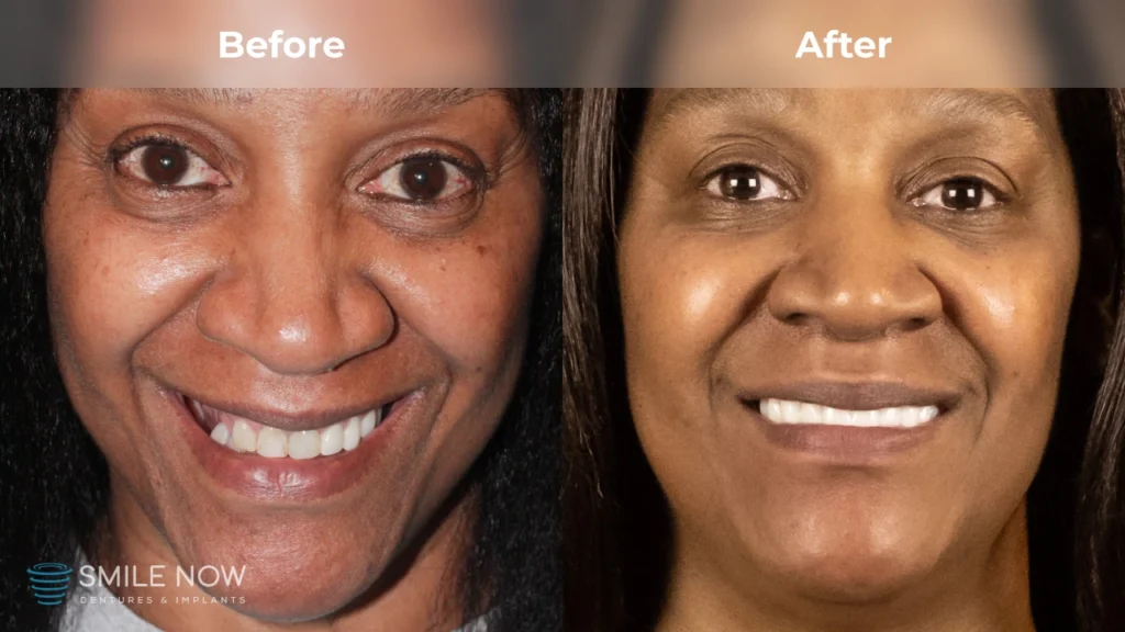 Before and after dental implants in Milwaukee, WI at Smile Now Milwaukee Dentures and Implants