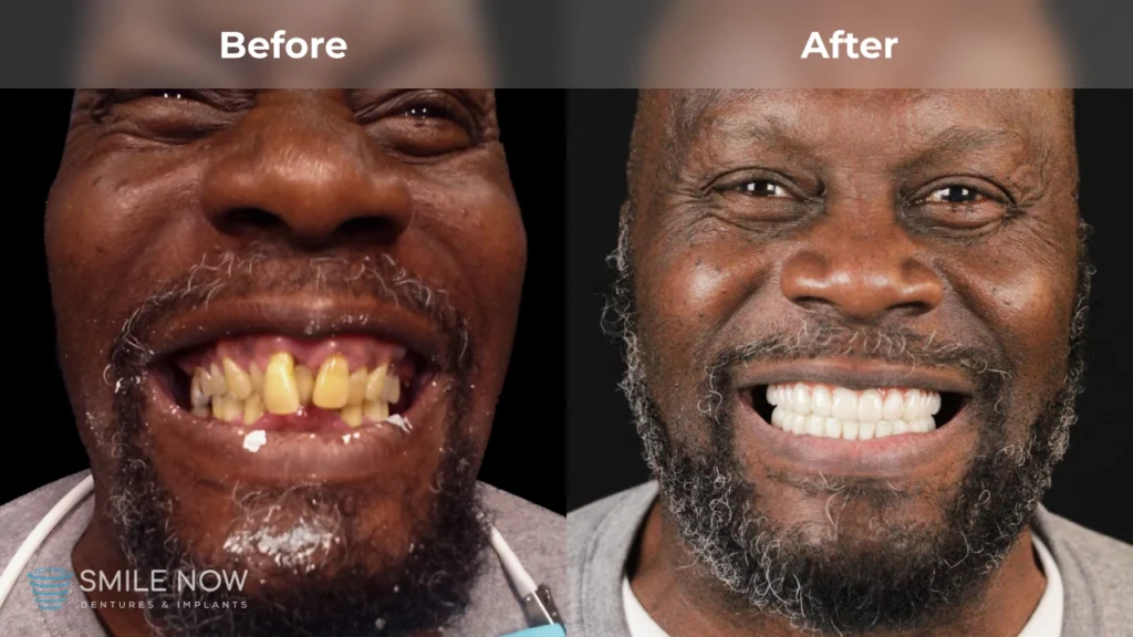 Before and after dental implants in Milwaukee, WI at Smile Now Milwaukee Dentures and Implants