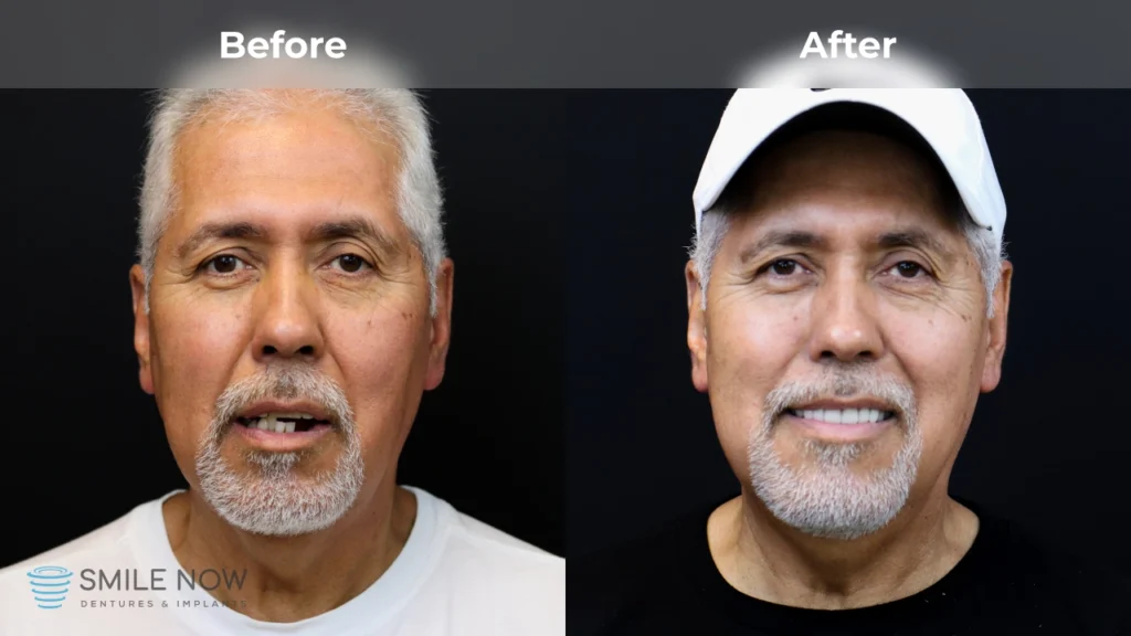 Before and after dental implants in Milwaukee, WI at Smile Now Milwaukee Dentures and Implants