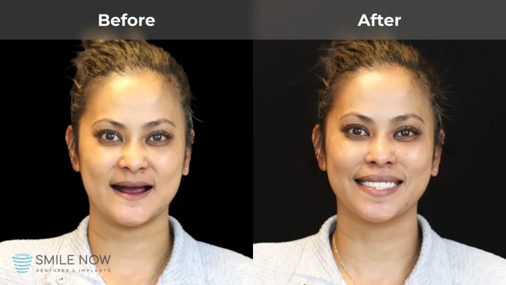 Before and after dental implants in Milwaukee, WI at Smile Now Milwaukee Dentures and Implants