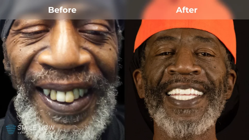 Before and after dental implants in Milwaukee, WI at Smile Now Milwaukee Dentures and Implants