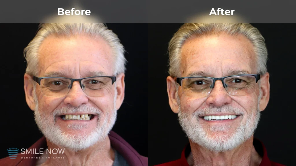 Before and after dental implants in Milwaukee, WI at Smile Now Milwaukee Dentures and Implants