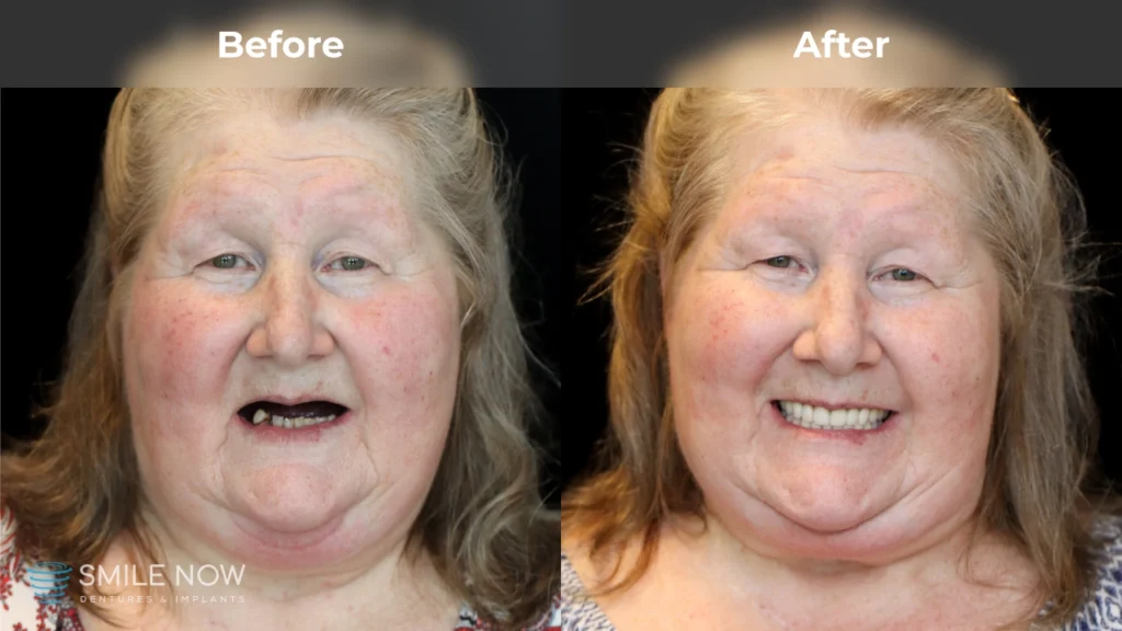 Before and after dental implants in Milwaukee, WI at Smile Now Milwaukee Dentures and Implants