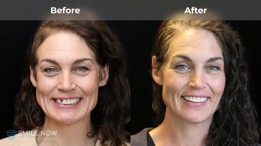 Before and after dental implants in Milwaukee, WI at Smile Now Milwaukee Dentures and Implants