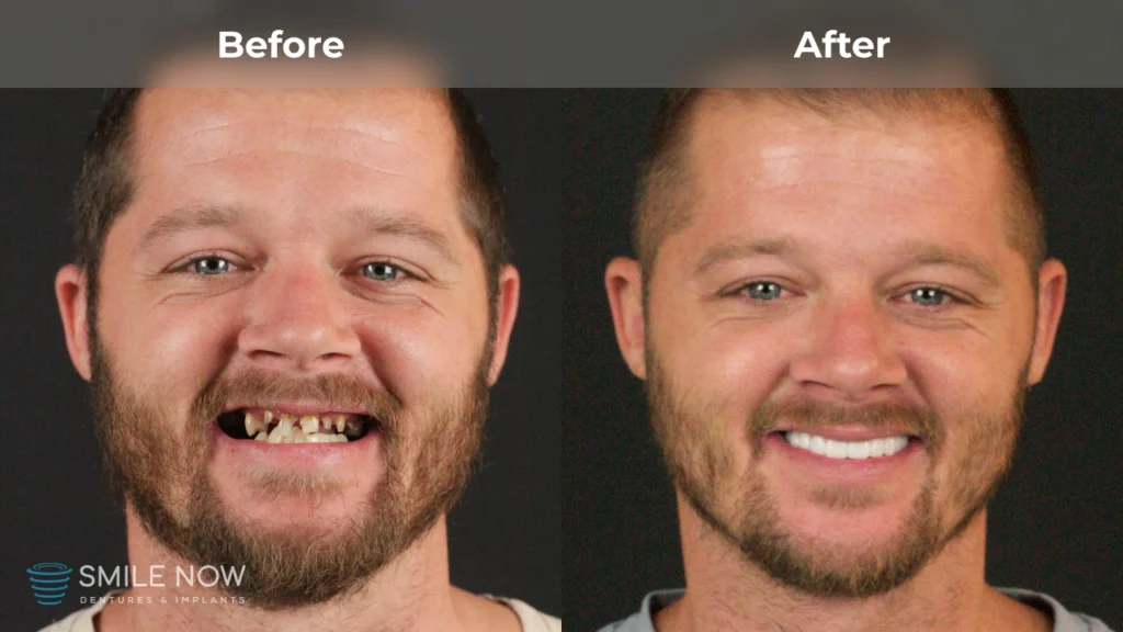 Before and after dental implants in Milwaukee, WI at Smile Now Milwaukee Dentures and Implants