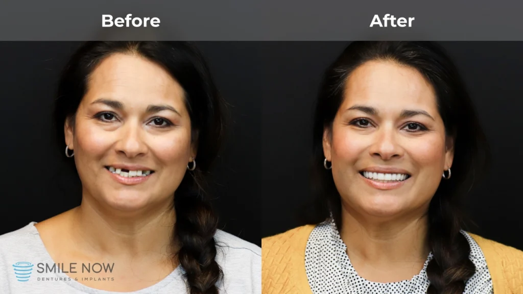 Before and after dental implants in Milwaukee, WI at Smile Now Milwaukee Dentures and Implants