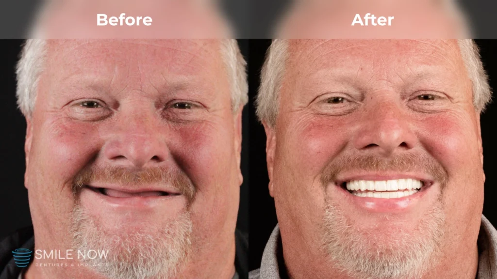 Before and after dental implants in Milwaukee, WI at Smile Now Milwaukee Dentures and Implants