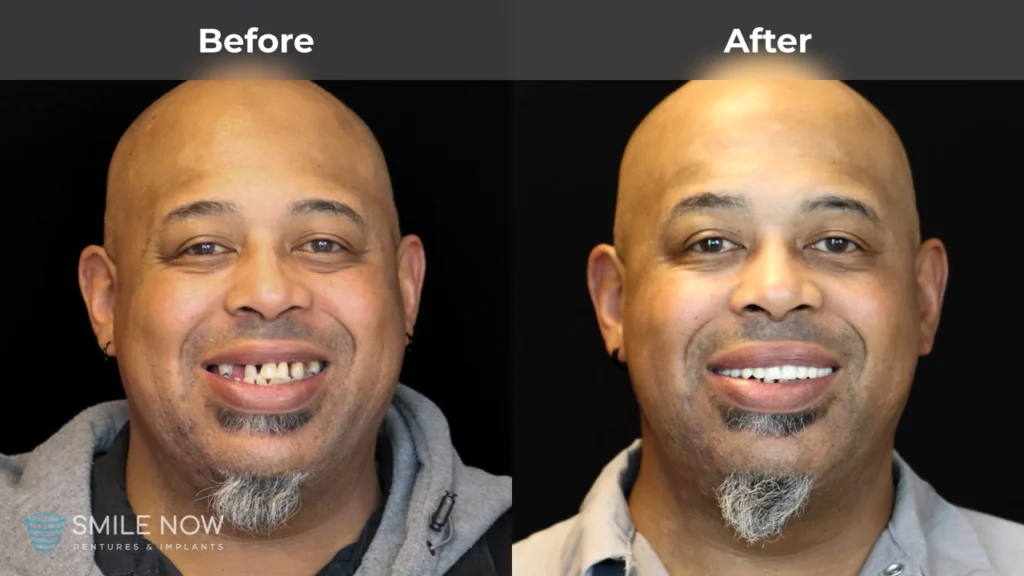 Before and after dental implants in Milwaukee, WI at Smile Now Milwaukee Dentures and Implants