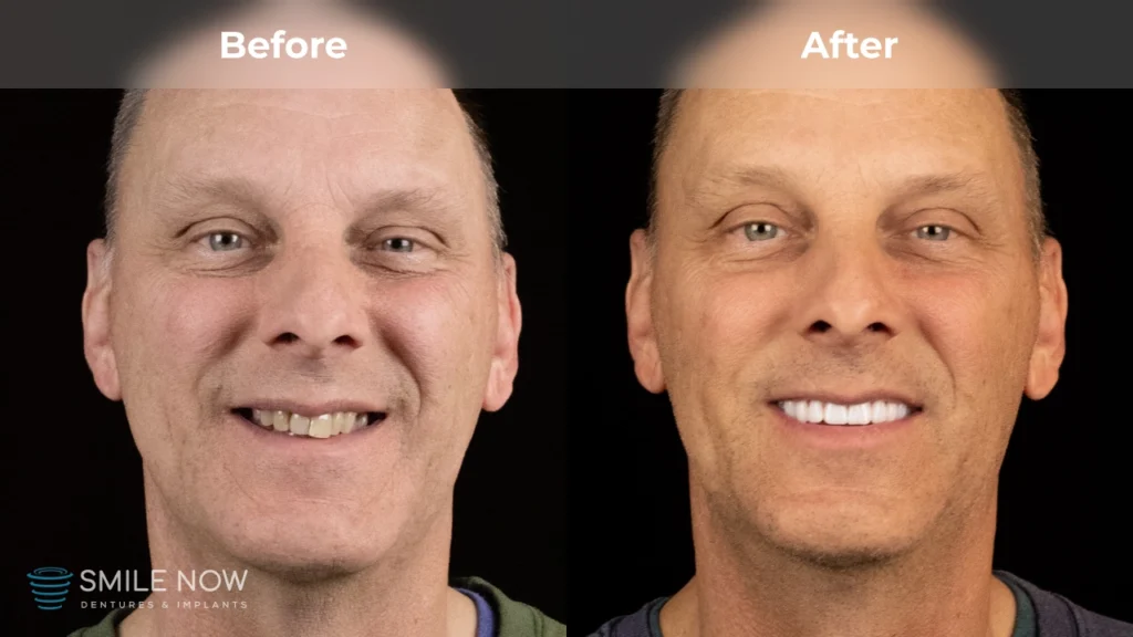 Before and after dental implants in Milwaukee, WI at Smile Now Milwaukee Dentures and Implants