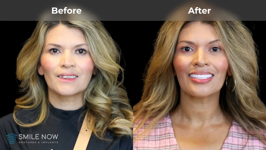 Before and after dental implants in Milwaukee, WI at Smile Now Milwaukee Dentures and Implants