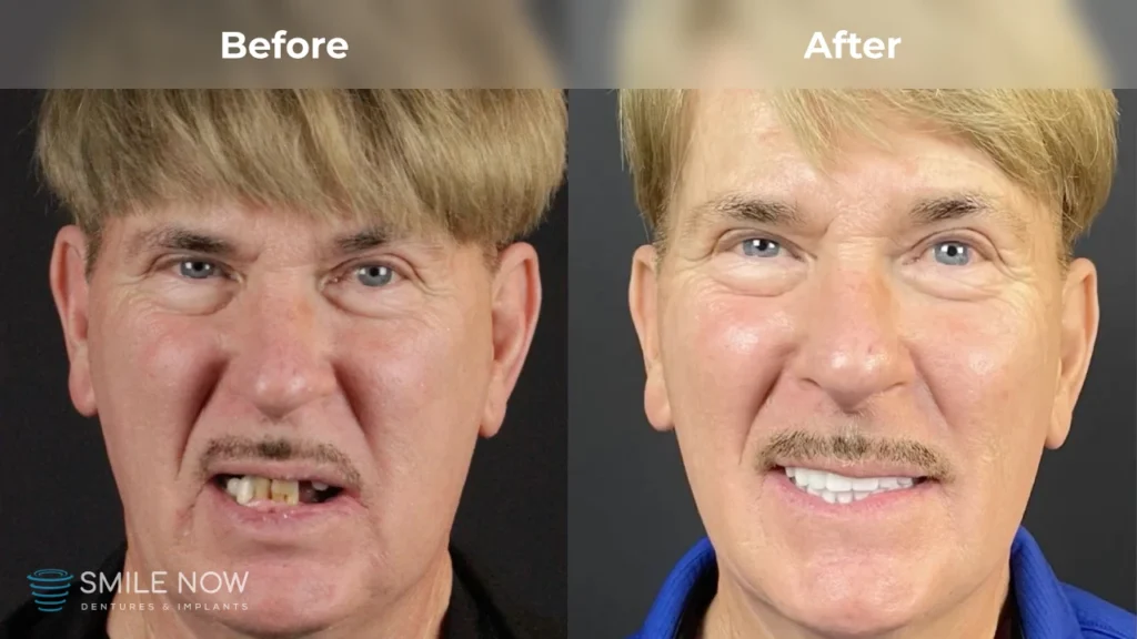 Before and after dental implants in Milwaukee, WI at Smile Now Milwaukee Dentures and Implants