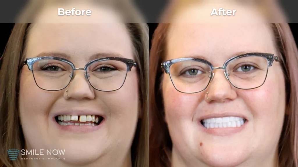 Before and after dental implants in Milwaukee, WI at Smile Now Milwaukee Dentures and Implants