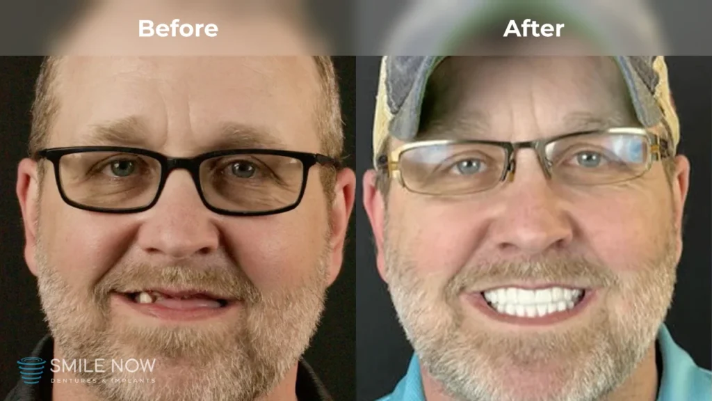 Before and after dental implants in Milwaukee, WI at Smile Now Milwaukee Dentures and Implants