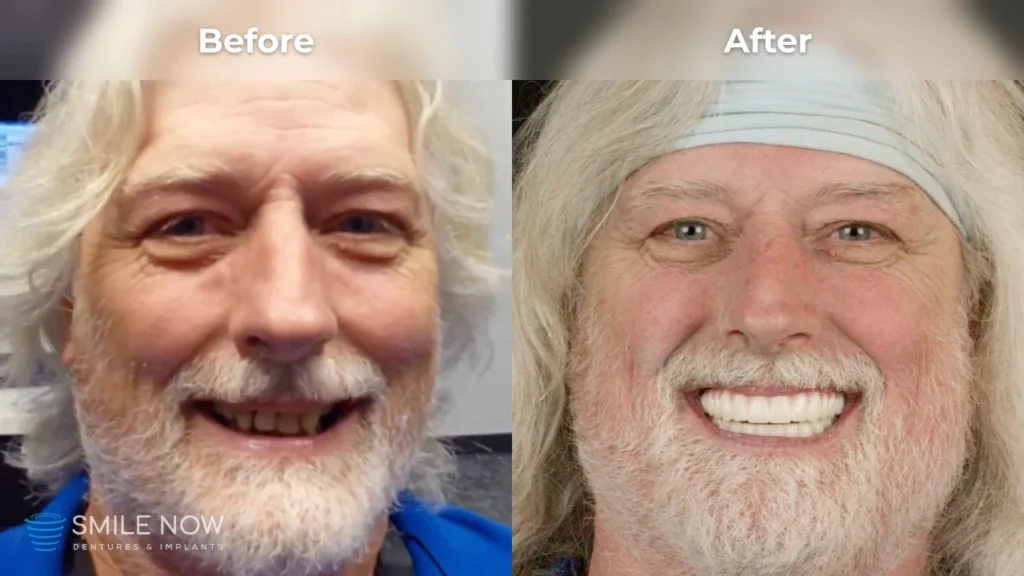 Before and after dental implants in Milwaukee, WI at Smile Now Milwaukee Dentures and Implants